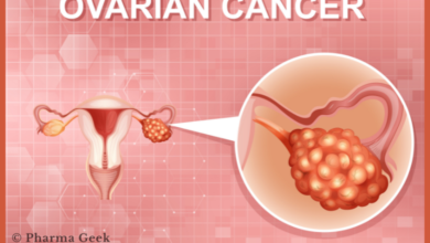 Ovarian Cancer