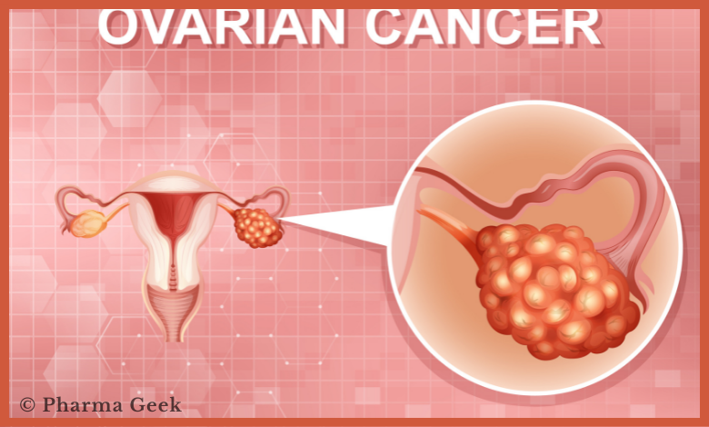 Clinical Trials Focusing on Prevention of Ovarian Cancer Underway